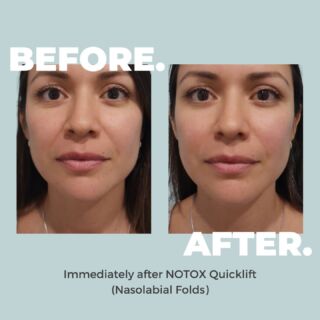 For BODY good results like these, all you need is 30 minutes!⏰⁠
When you're short on time, but big on glam, the NOTOX QuickLift has got you covered!😉✨⁠
⁠
🎯Target specific areas of your face and neck with HIFU⁠
🎯Treatment areas include: Forehead, brows, crow’s feet, cheeks, chin & submentum⁠
🎯Achieve long-lasting lift in 30 minutes without surgery, needles or downtime⁠
🎯NOW $199 (was $299) ⁠
⁠
Click the link in bio QUICK, because this BODY good deal won’t last long!🤑⁠
⁠
#notox #notoxtransform #notoxskin #selfcare #skincare #beauty #healthyskin #antiageing #skin #glow #lift #wrinklereduction #bodycatalyst #skintransformation #hifu⁠ #facial #botox #feelbodygood #feelbodygoodsale #quicklift #hifuquicklift #notoxquicklift #nonsurgicalfacelift⁠